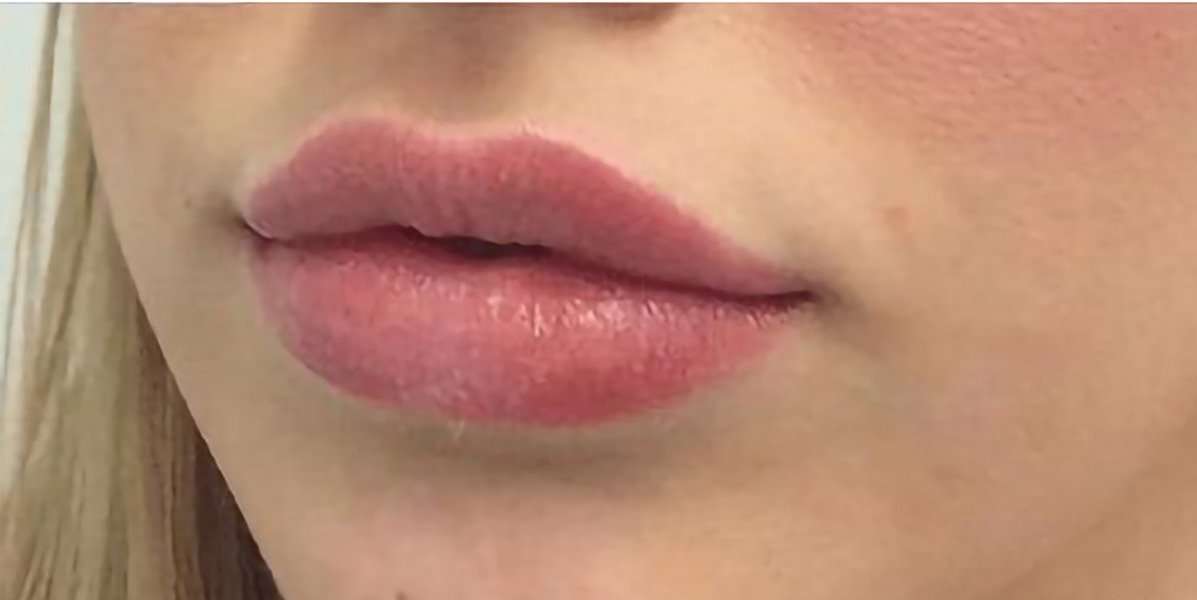 Lip filler after