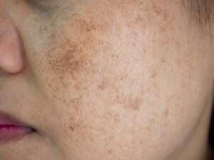 hyperpigmentation, what causes hyperpigmentation