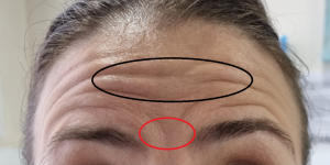 botox forehead lines and forwn lines